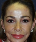 Feel Beautiful - Browlift Case 1 - After Photo
